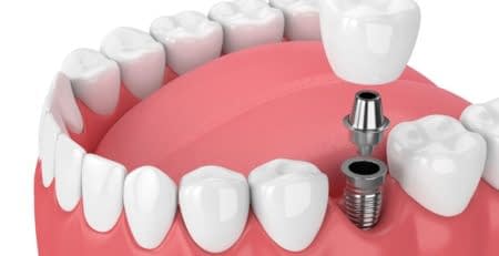 5 أسباب تجعل زراعة الأسنان مهمة للغاية