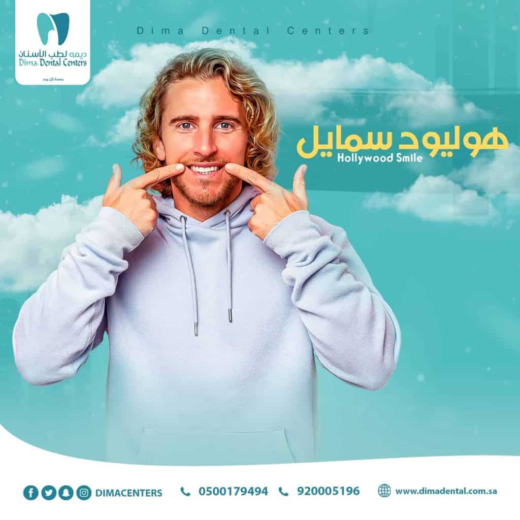 ما هي أنواع هوليود سمايل ؟ وفوائدها في مركز ديما لطب الأسنان 6 هوليود سمايل