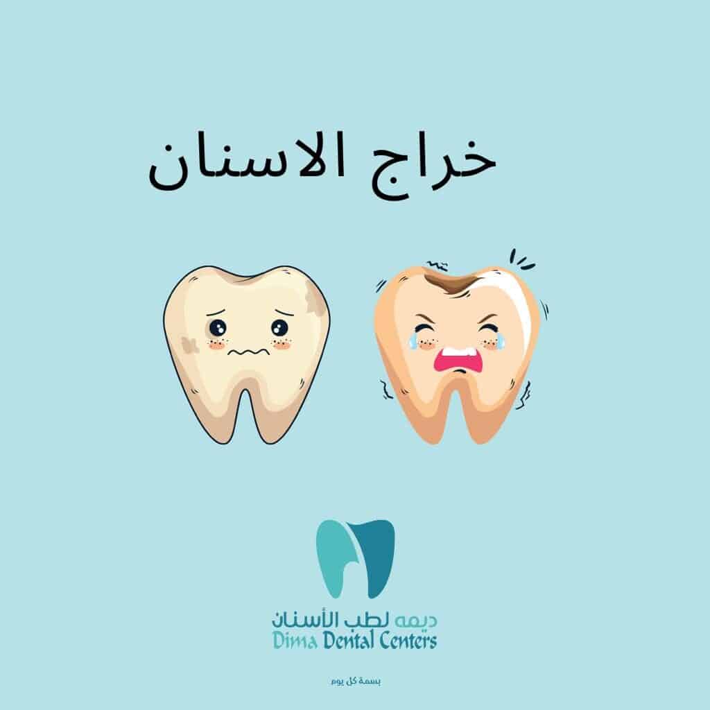 خراج الأسنان والتعامل معه 6 خراج الأسنان | خراج اللثة | ديما