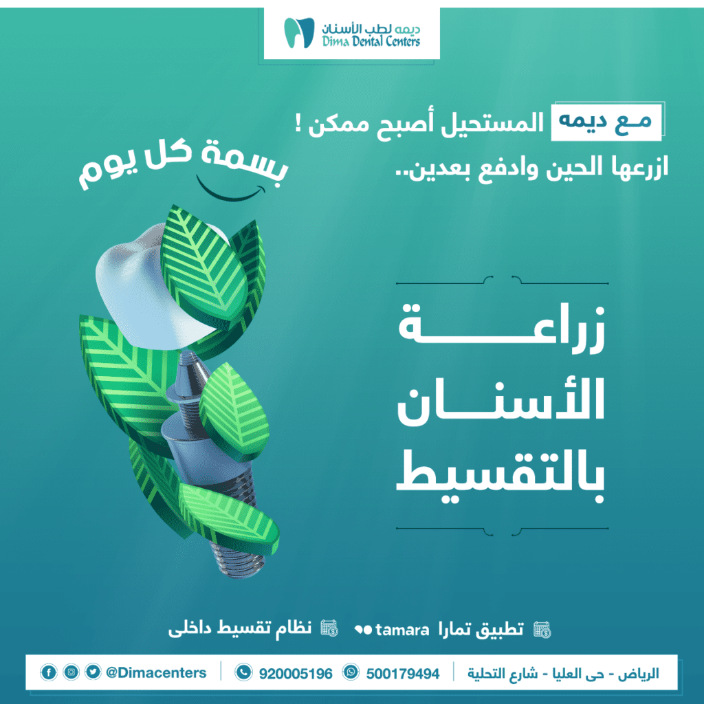 زراعة الاسنان الفورية اسعار زراعة الاسنان