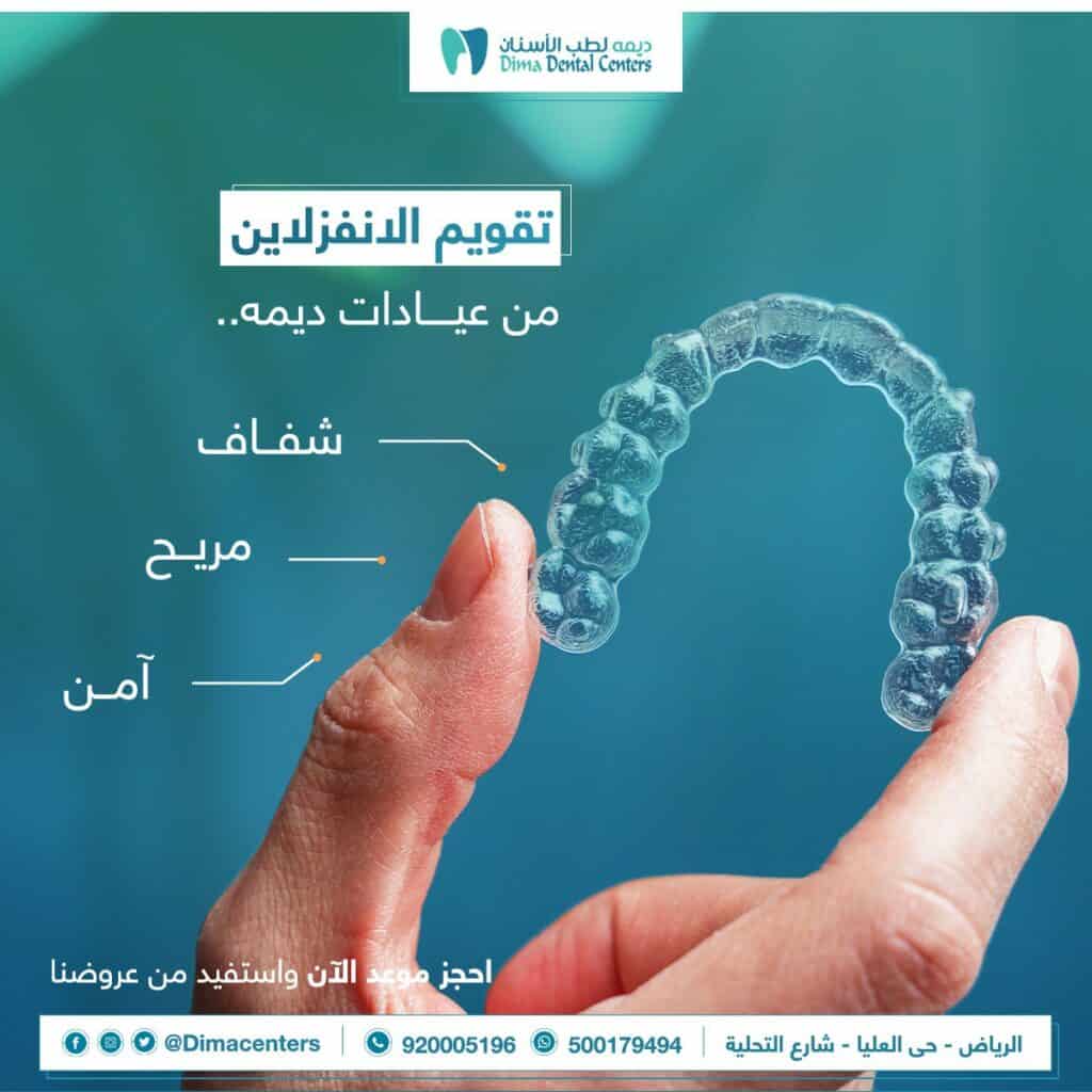 تقنية الانفزلاين glamsmileالعدسات السنية اللاصقة Glamsmile