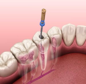 جذور الاسنان | حشوات الاسنان | ديما