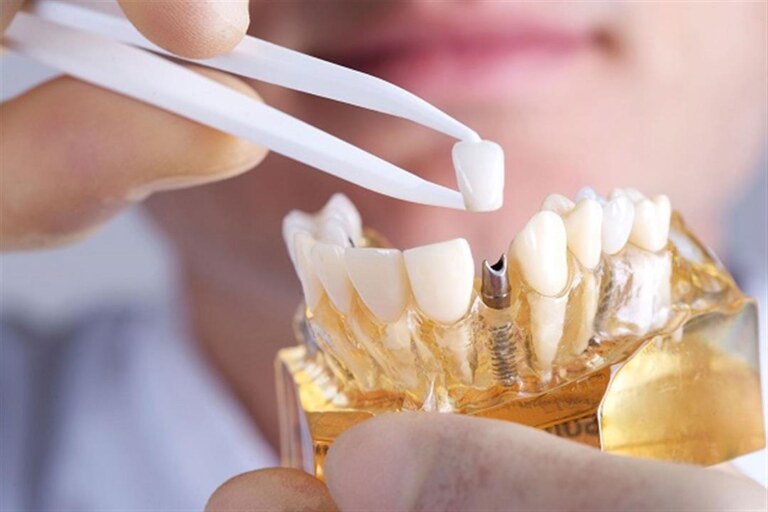 كيف اعرف فشل زراعة الاسنان