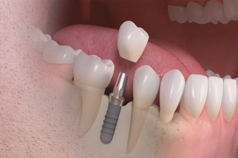 أهمية وتد الاسنان بعد إزالة العصب وتكملة علاج السن