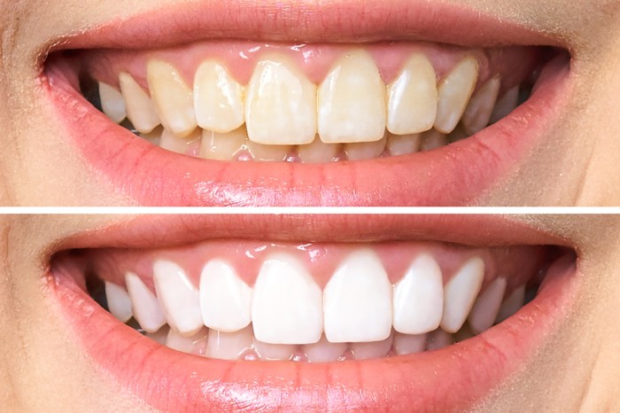 ما هو الفرق الجوهري بين إبتسامة هوليوود وتبييض الاسنان؟
