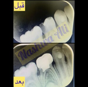 تجميل الاسنان عن طريق الحشوات من خلال الدكتورة نشوي