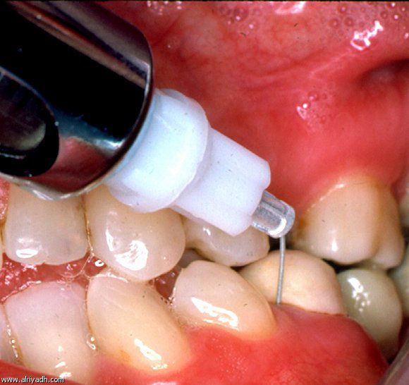 الموضعي للأسنان التخدير الكامل للاطفال للاسنان