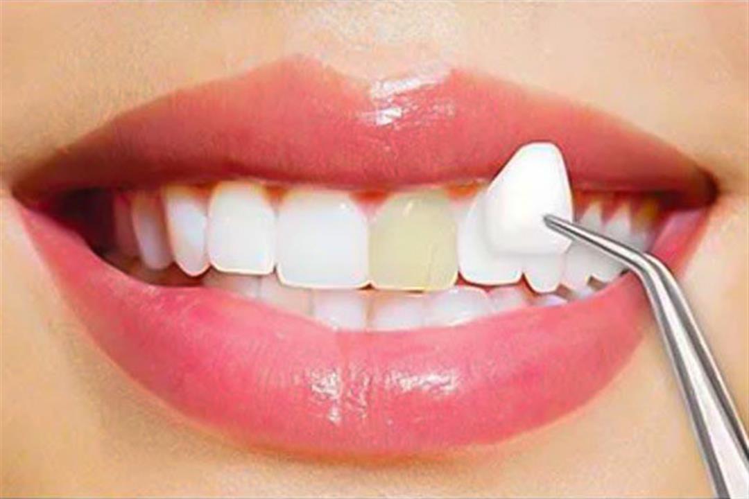 فينير الاسنان | فينير | ديما لطب الاسنان