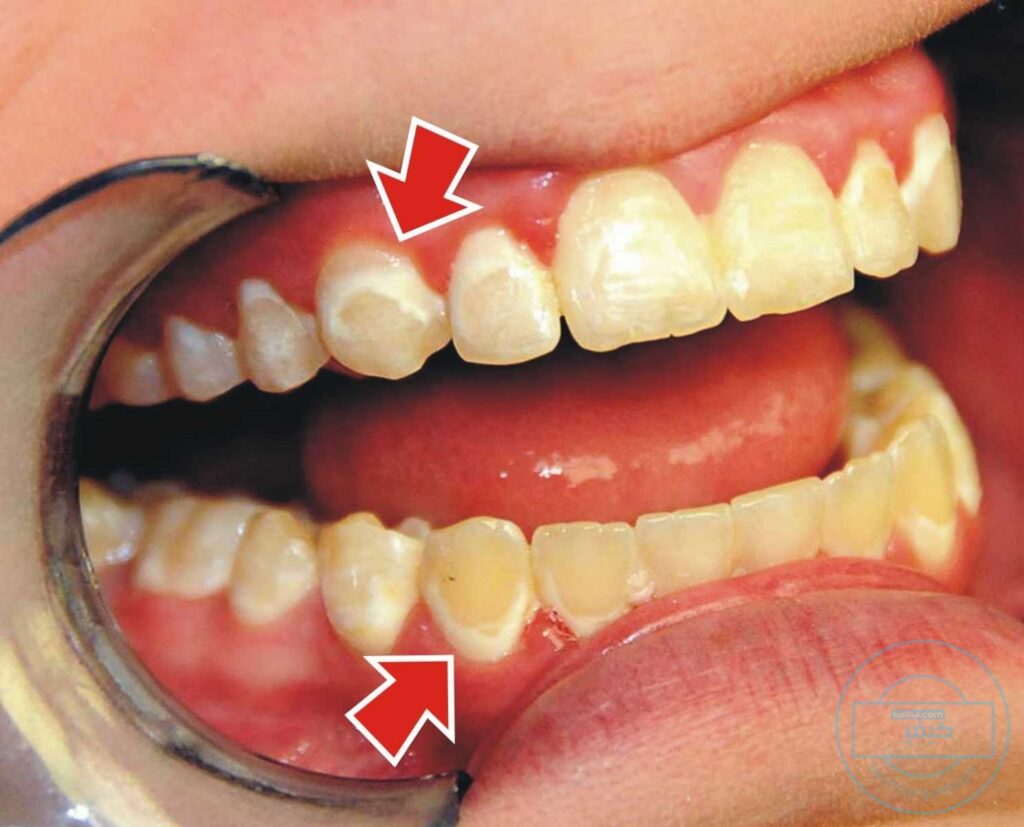 البلاك في الاسنان