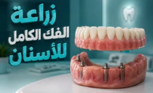 زراعة الفك الكامل للأسنان