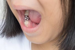 طربوش الأسنان للأطفال