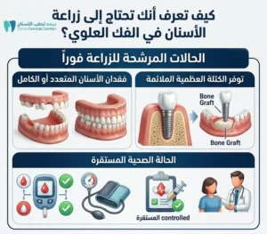 زراعة الأسنان في الفك العلوي