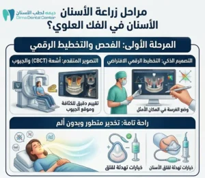 زراعة الاسنان في الفك العلوي