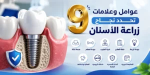 نجاح زرعة الأسنان