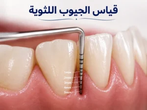 علاج التهاب اللثة لمرضى السكري وتقرحات الفم | الأسباب والعلاج 10 علاج الجيوب اللثوية